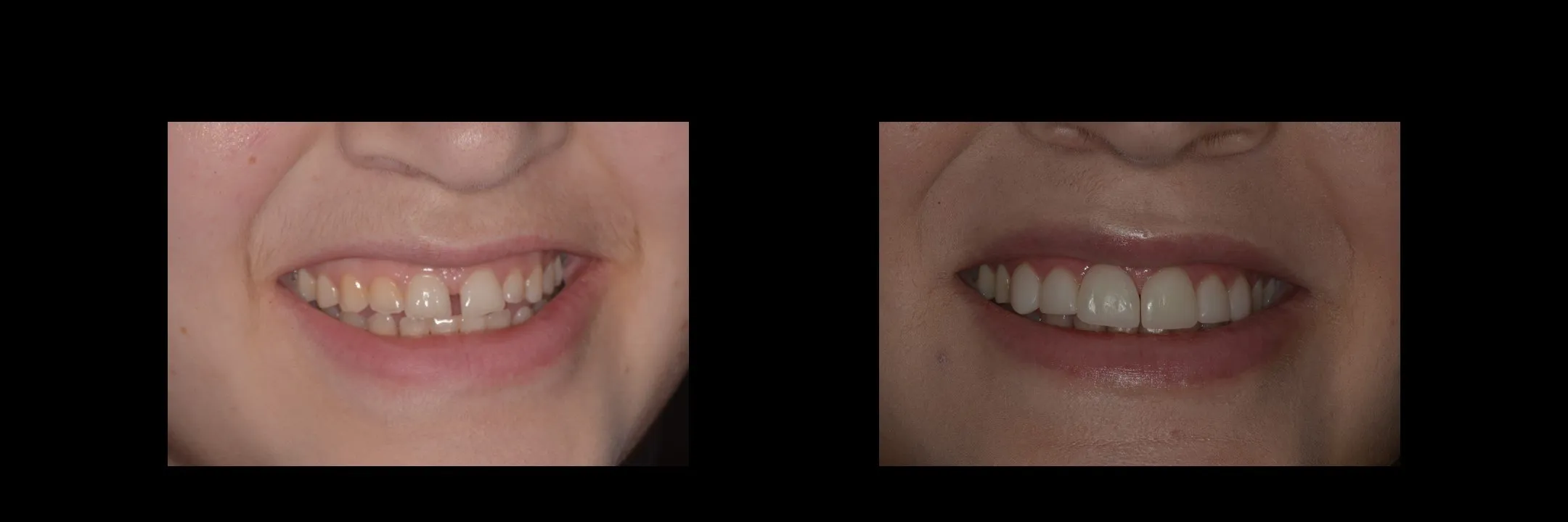 Before and After Minimally Prepared Veneers photo 3