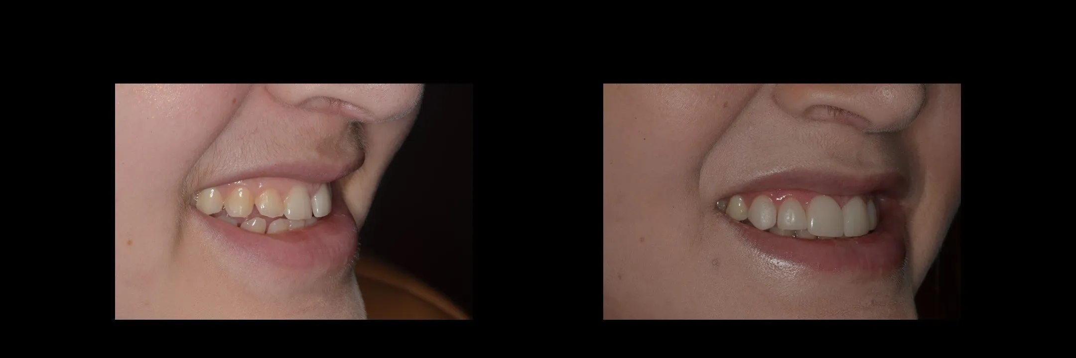 Before and After Minimally Prepared Veneers photo 4