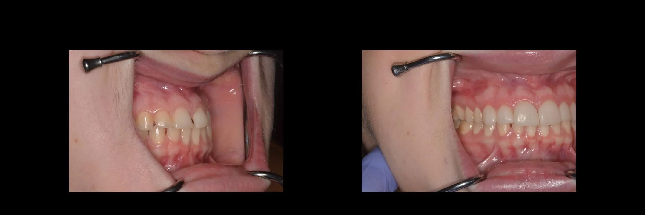 Before and After Minimally Prepared Veneers photo 7