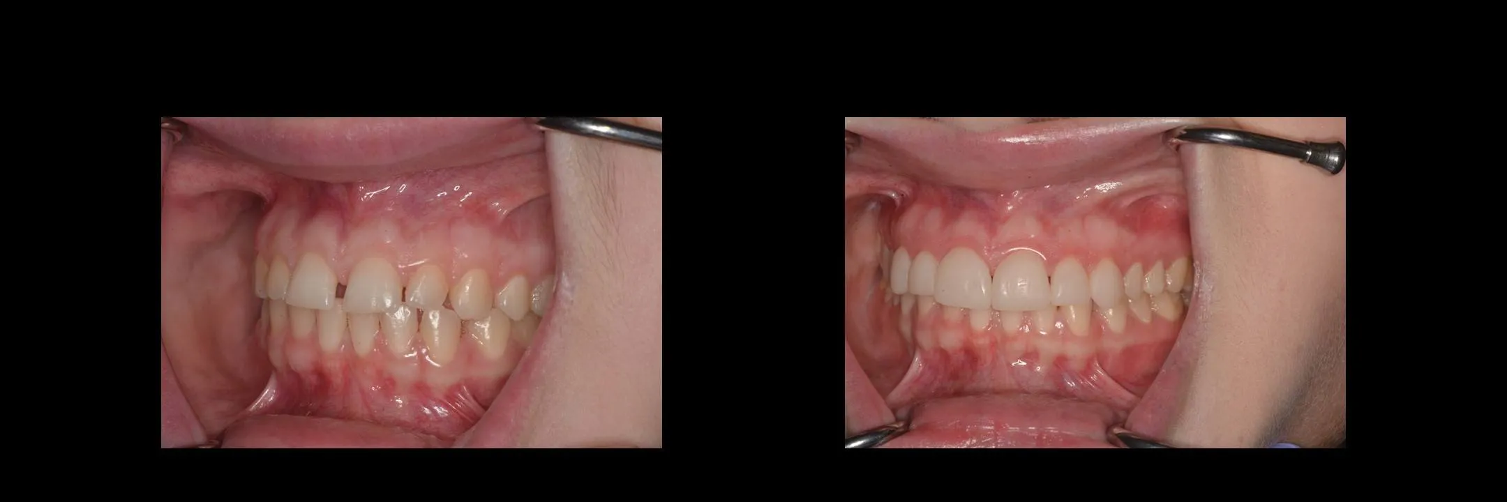 Before and After Minimally Prepared Veneers photo 8