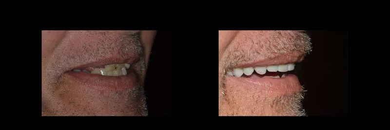 Before and After Full-Mouth Rehabilitation photo 4