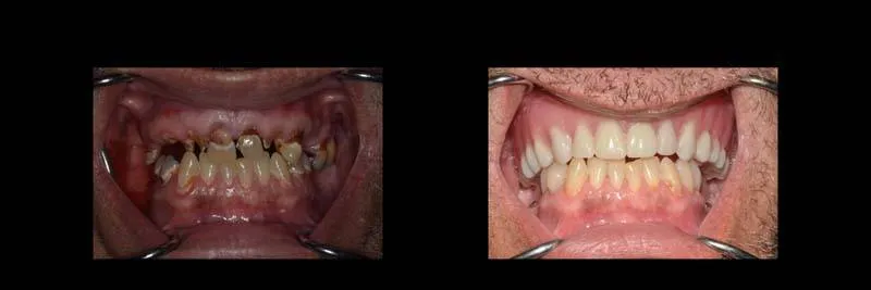 Before and After Full-Mouth Rehabilitation photo 6