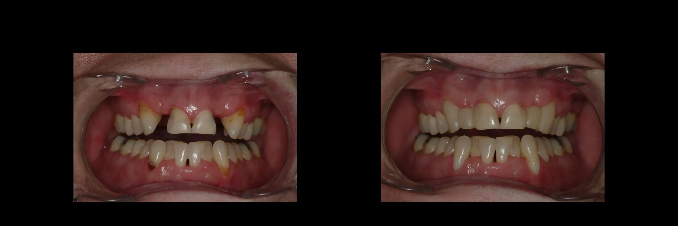 Before and After Provisional/Temporary Bridges photo 5