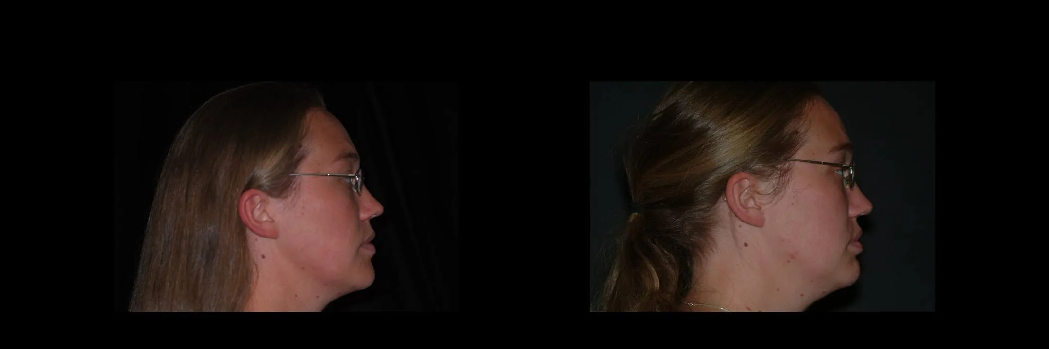 Before and After Porcelain Veneers photo 4