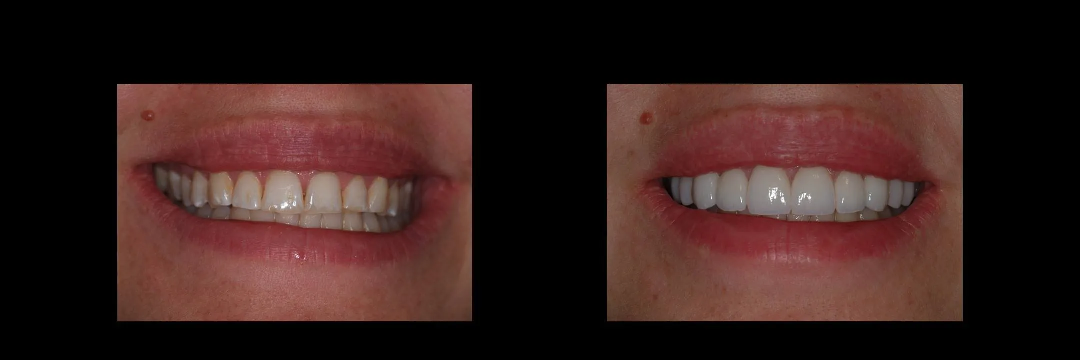 Before and After Porcelain Veneers photo 5