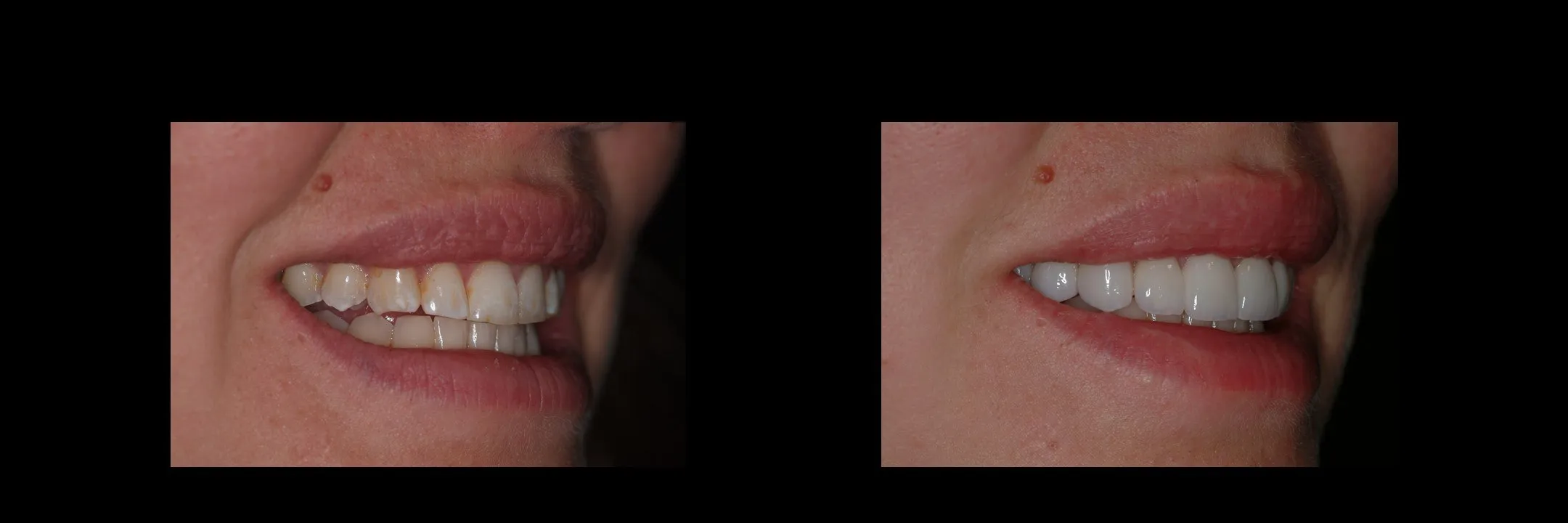 Before and After Porcelain Veneers photo 6