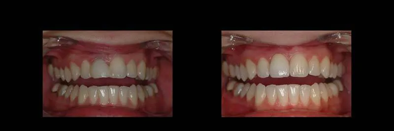 implants photo 10