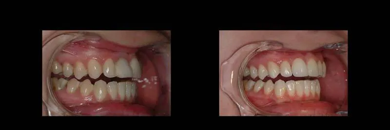 implants photo 11