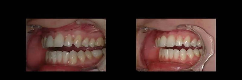 implants photo 12