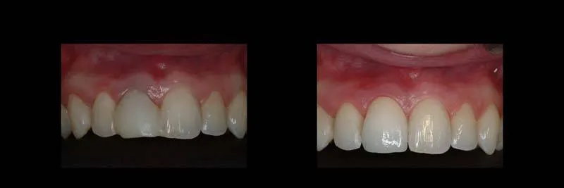 implants photo 13