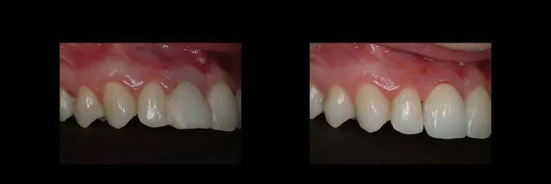 implants photo 14