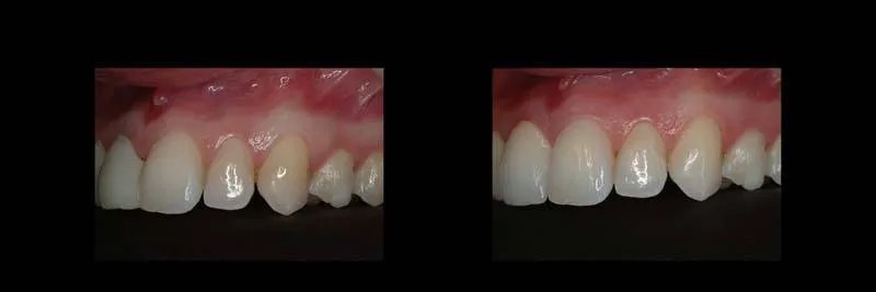 implants photo 15