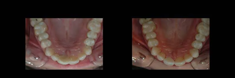 implants photo 16