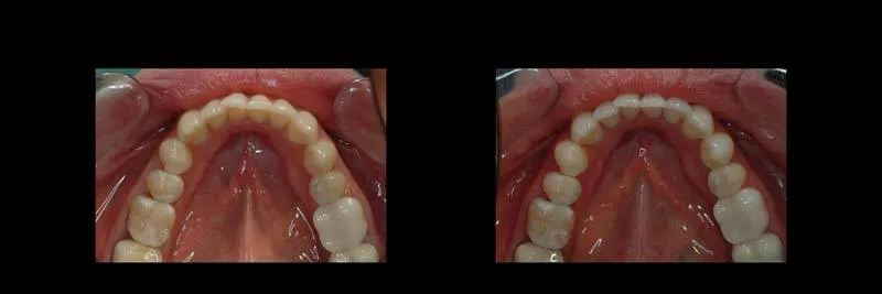 implants photo 17