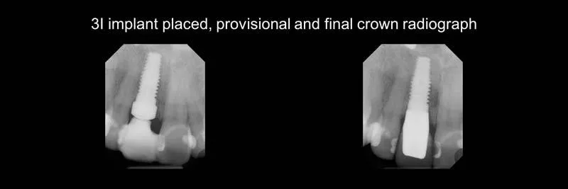 implants photo 3
