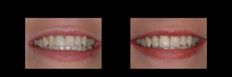 implants photo 7