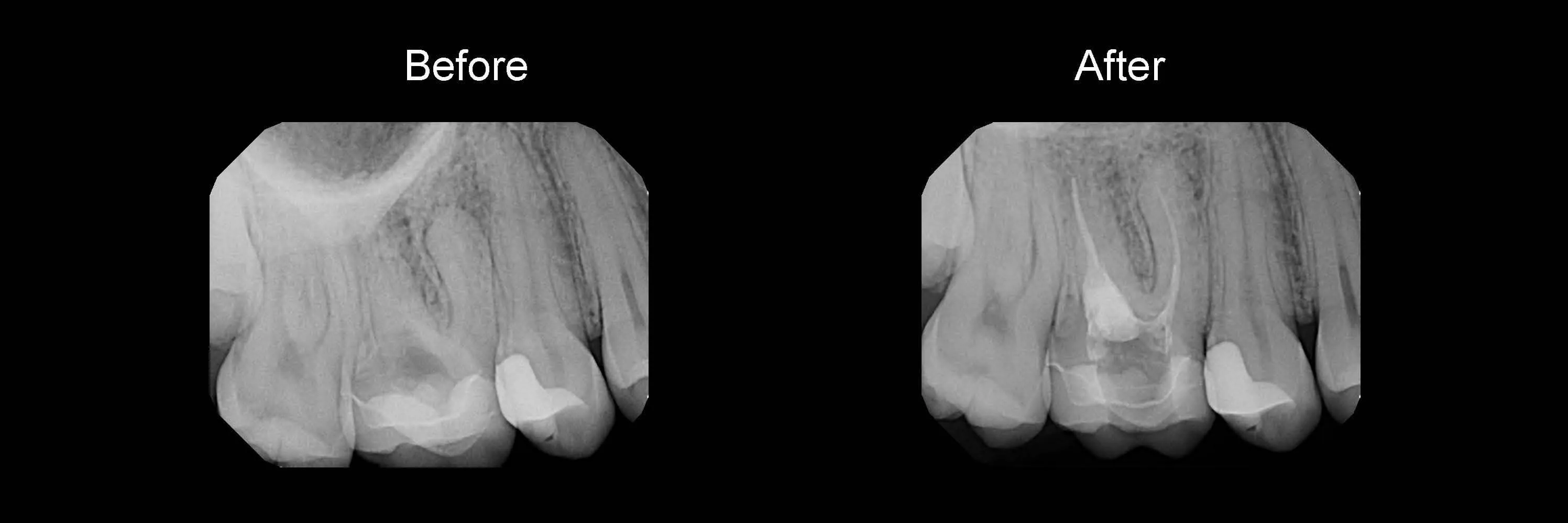 Before and After Safe Root Canals Using Sonendo photo 6