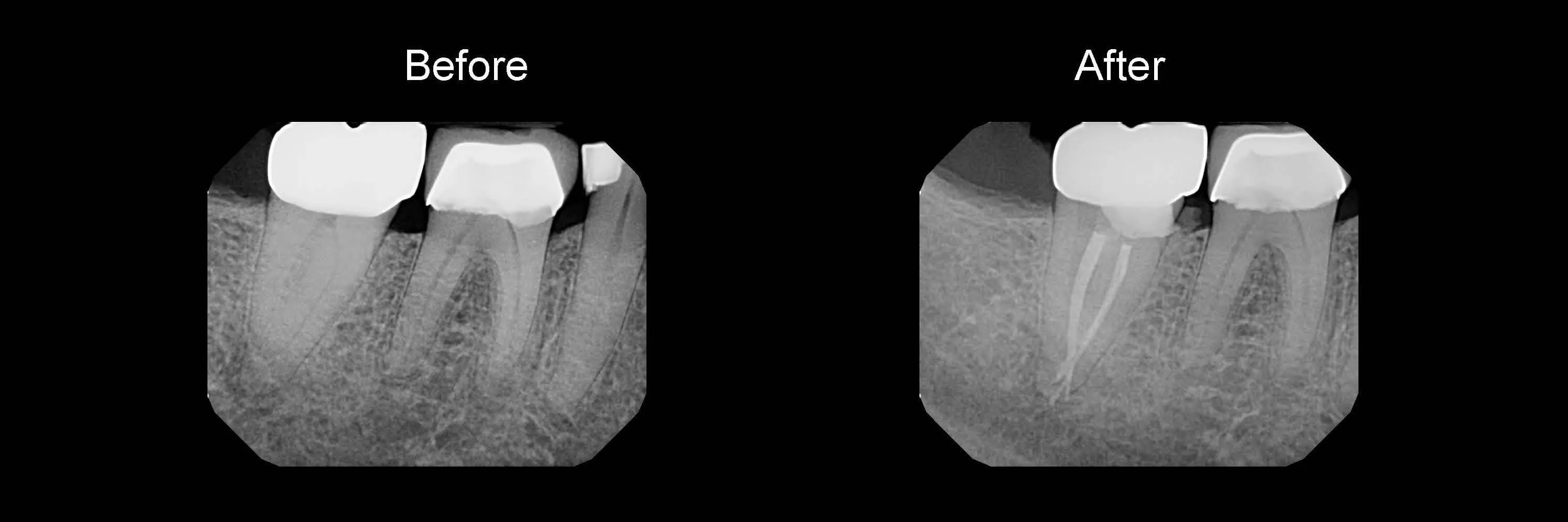 Before and After Safe Root Canals Using Sonendo photo 12