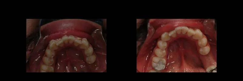 Before and After Composite Restoration & Hygiene Coaching photo 12