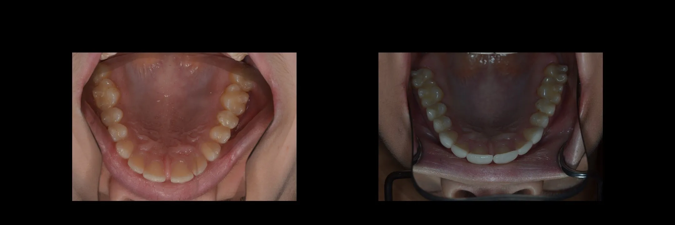 Before and After Minimally Prepared Veneers photo 13
