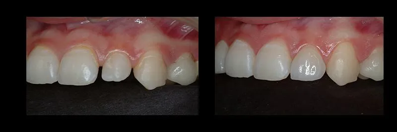 Before and After No Prepartion Veneers photo 10