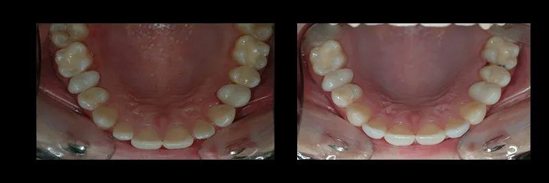 Before and After No Prepartion Veneers photo 11