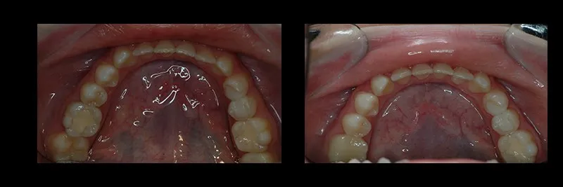 Before and After No Prepartion Veneers photo 12
