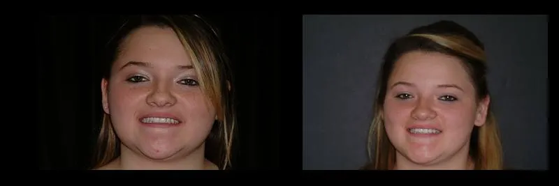 Before and After No Prepartion Veneers photo 14