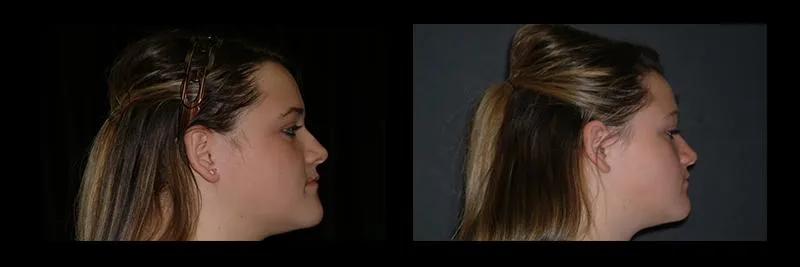 Before and After No Prepartion Veneers photo 15