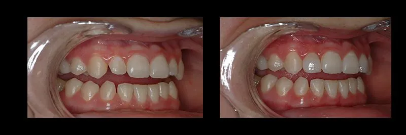 Before and After No Prepartion Veneers photo 6