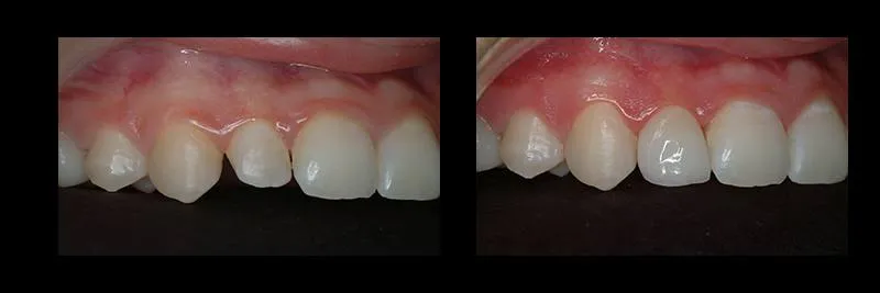 Before and After No Prepartion Veneers photo 9